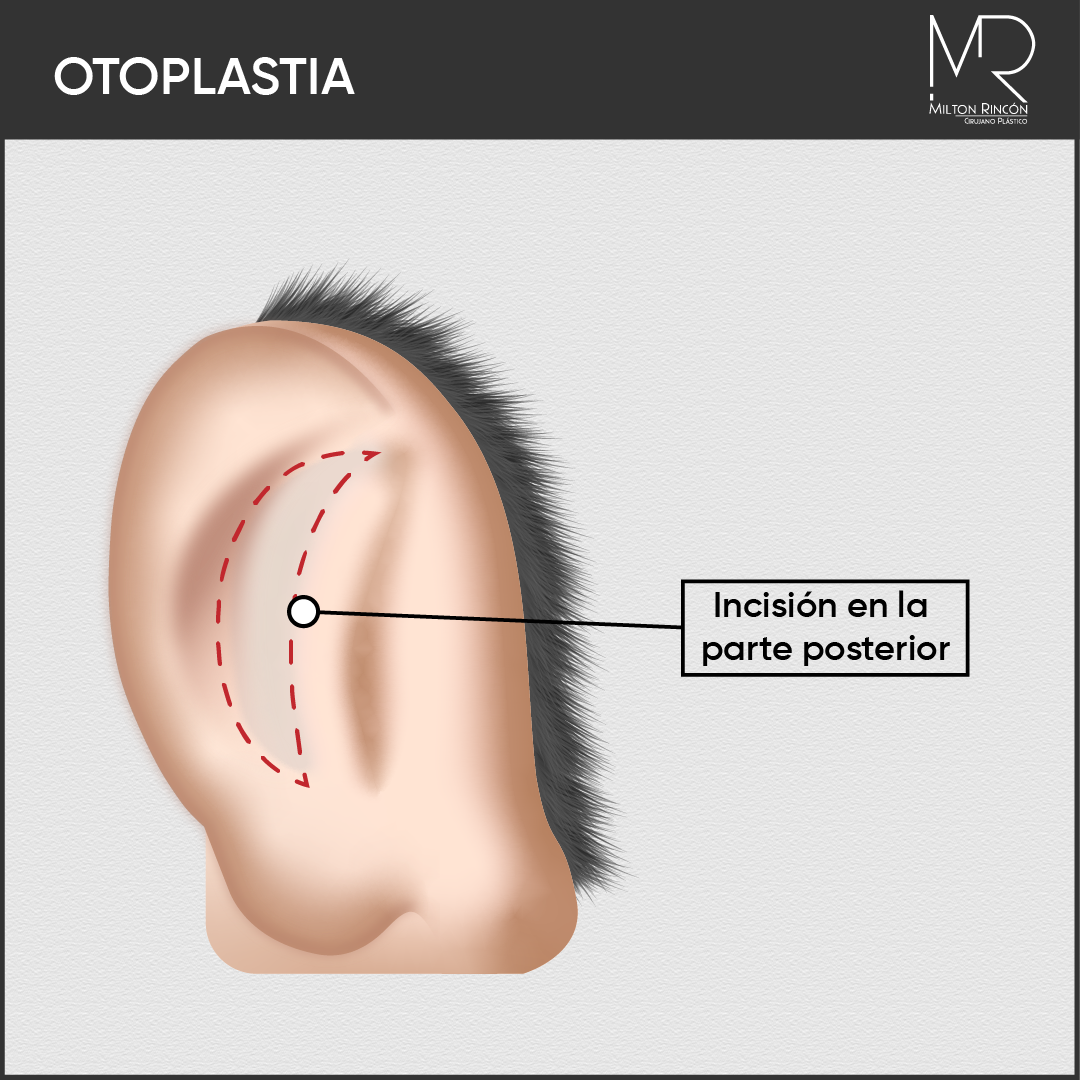 Evolución de abdominoplastia
